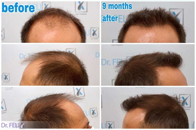 imagine de tip before and after cu implant de par