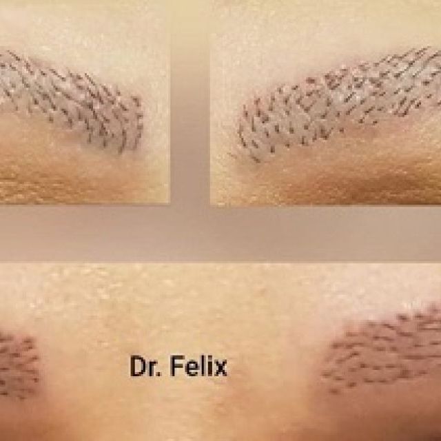 Cand este timpul perfect pentru implantul de sprancene? Afla de la clinica Dr. Felix Hair Implant 