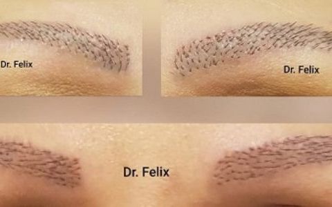 Cand este timpul perfect pentru implantul de sprancene? Afla de la clinica Dr. Felix Hair Implant